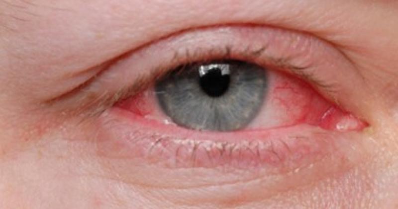 صحتك بالدنيا.. نصائح تساهم في علاج أنفلونزا العيون في الخريف